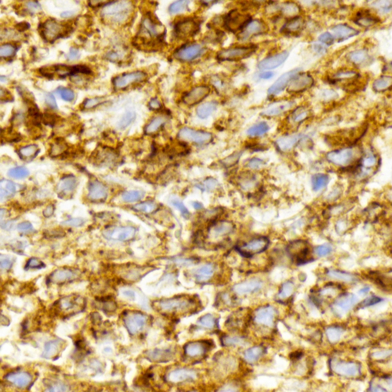 Pathology Outlines Primary cutaneous diffuse large B cell lymphoma