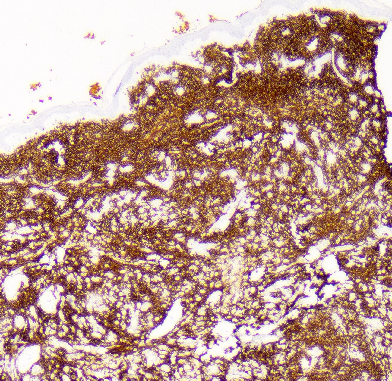Pathology Outlines Diffuse large B cell lymphomaleg