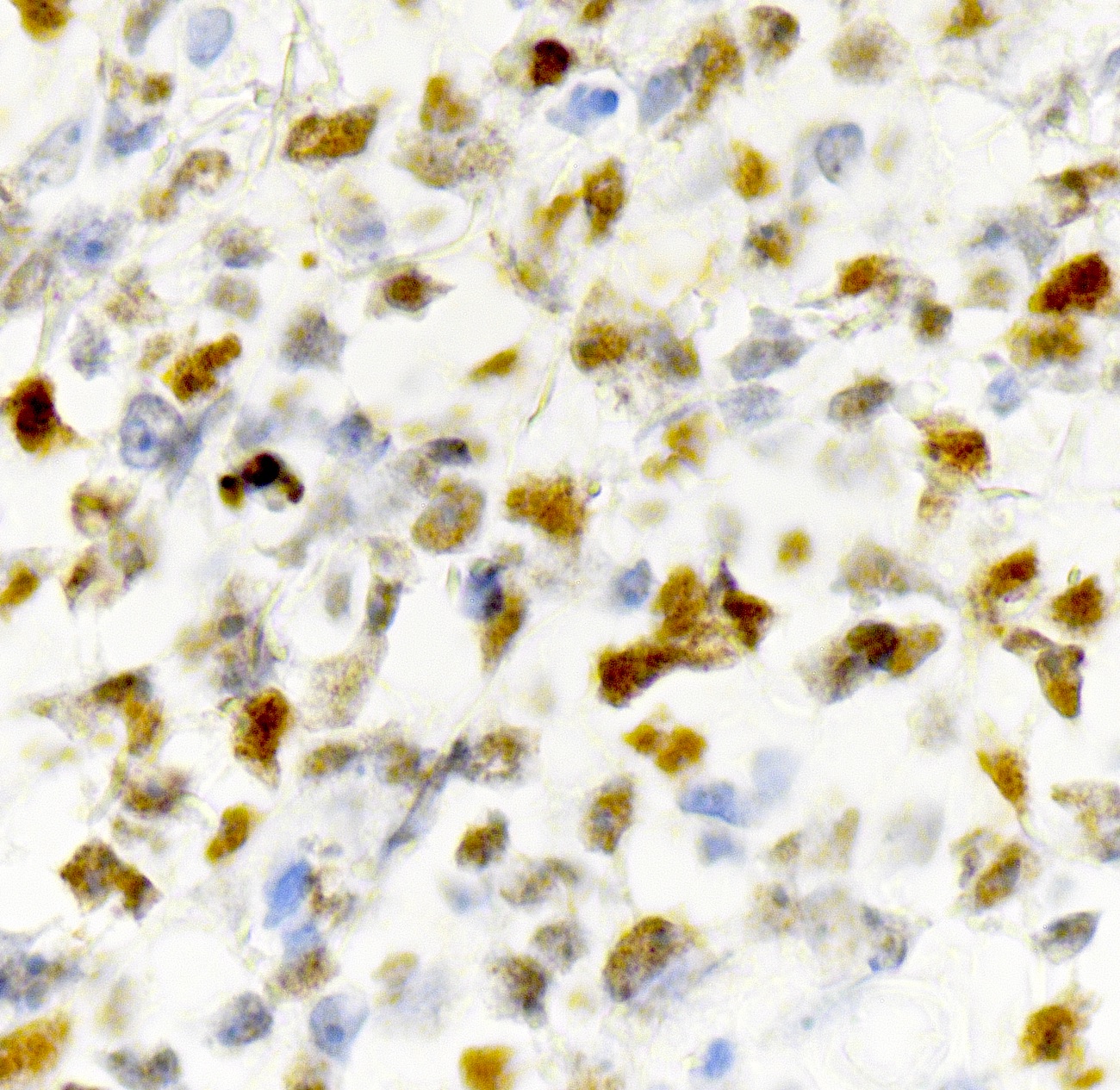 Pathology Outlines Primary cutaneous diffuse large B cell lymphoma