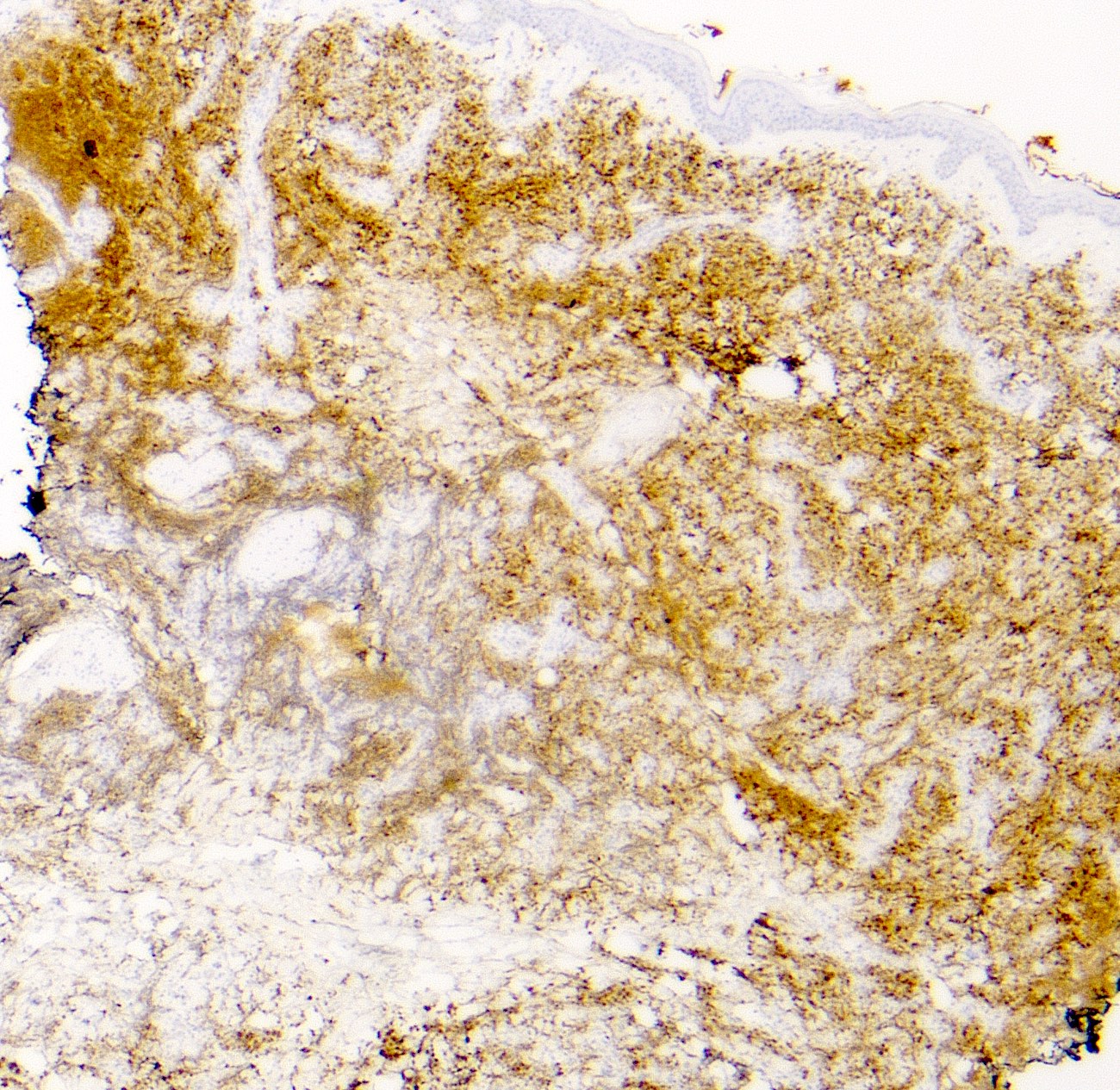 Pathology Outlines Primary cutaneous diffuse large B cell lymphoma