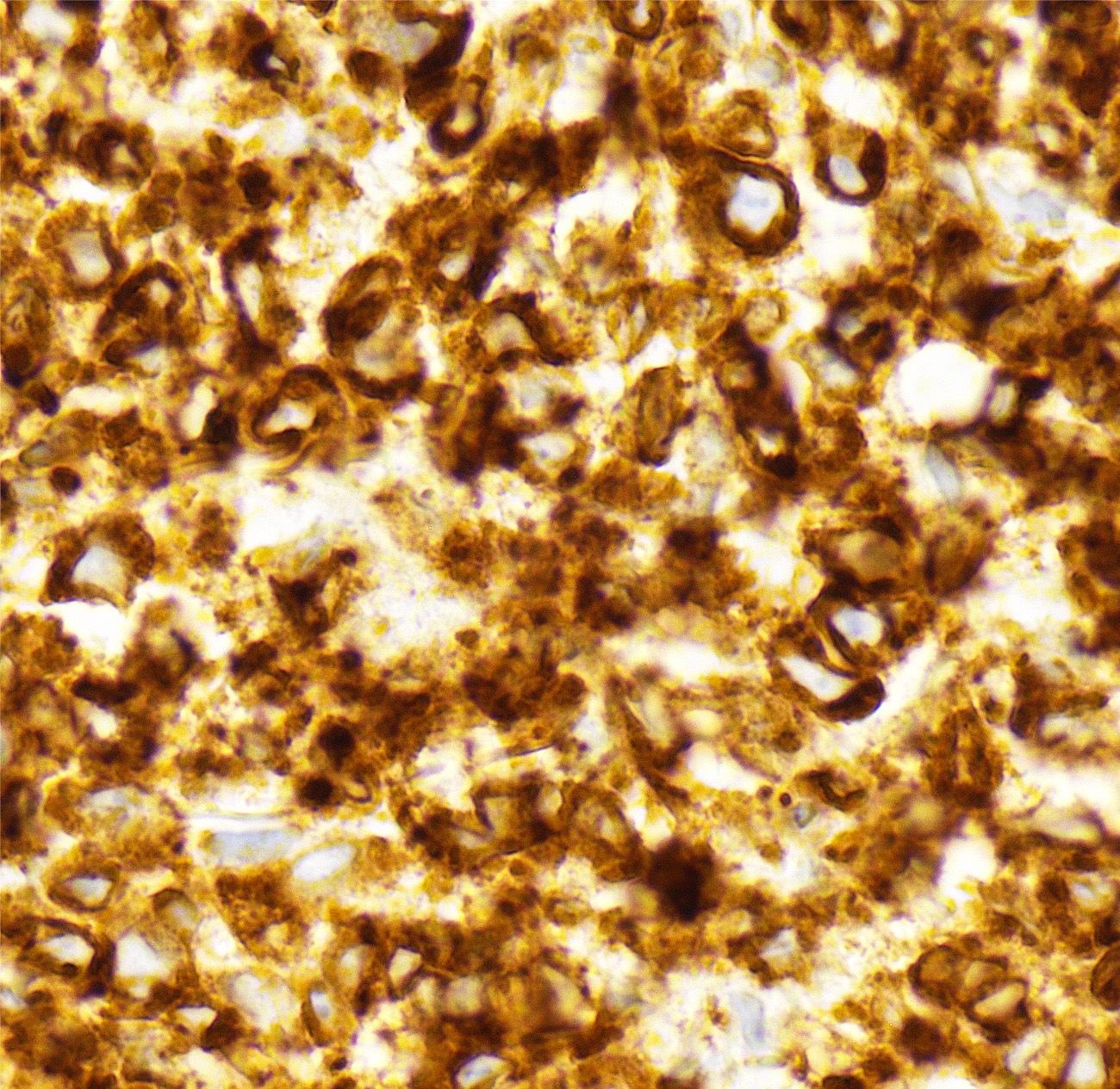 Pathology Outlines Primary cutaneous diffuse large B cell lymphoma