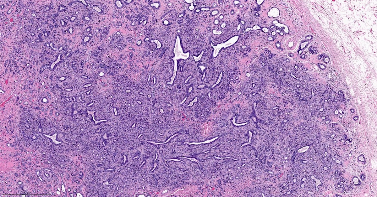 Pathology Outlines Adenomyoepithelioma & malignant adenomyoepithelioma