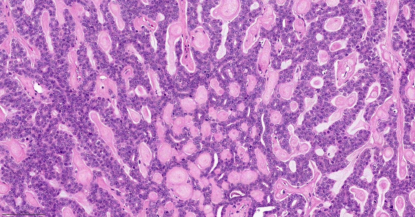 Pathology Outlines Adenomyoepithelioma & malignant adenomyoepithelioma