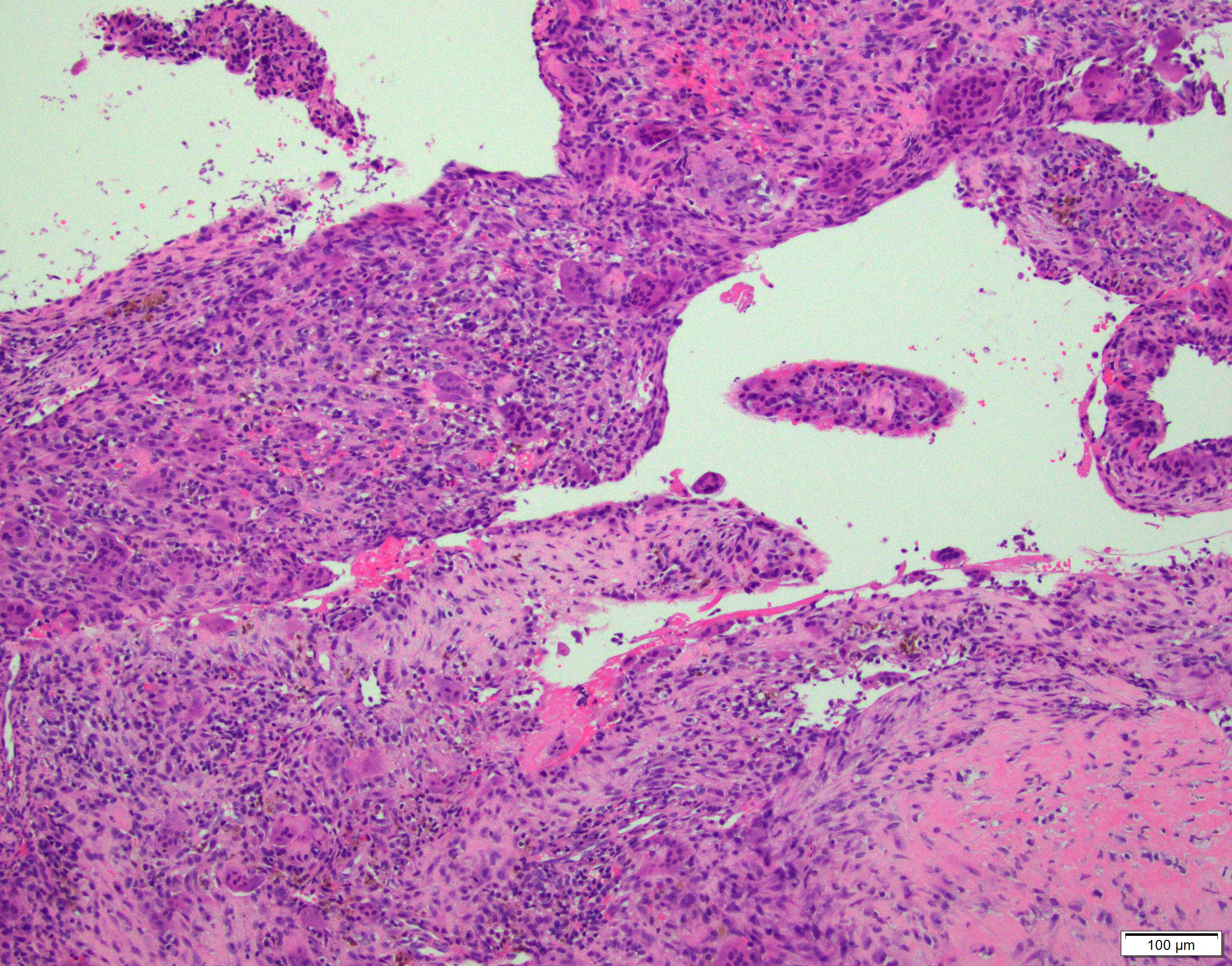 Pathology Outlines Aneurysmal bone cyst