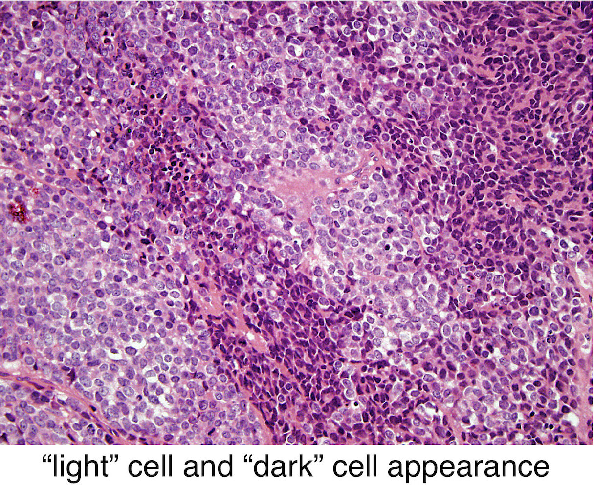 Pathology Outlines Ewing /