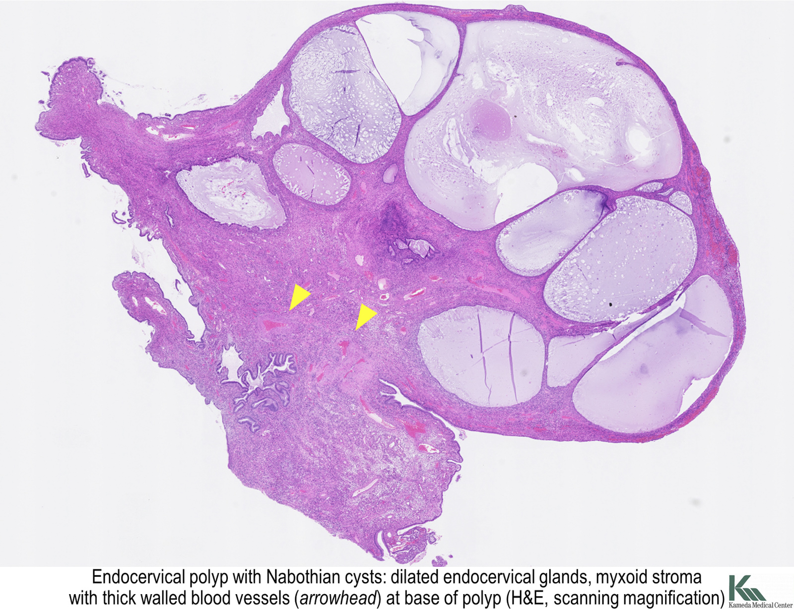 Pathology Outlines Endocervical polyp