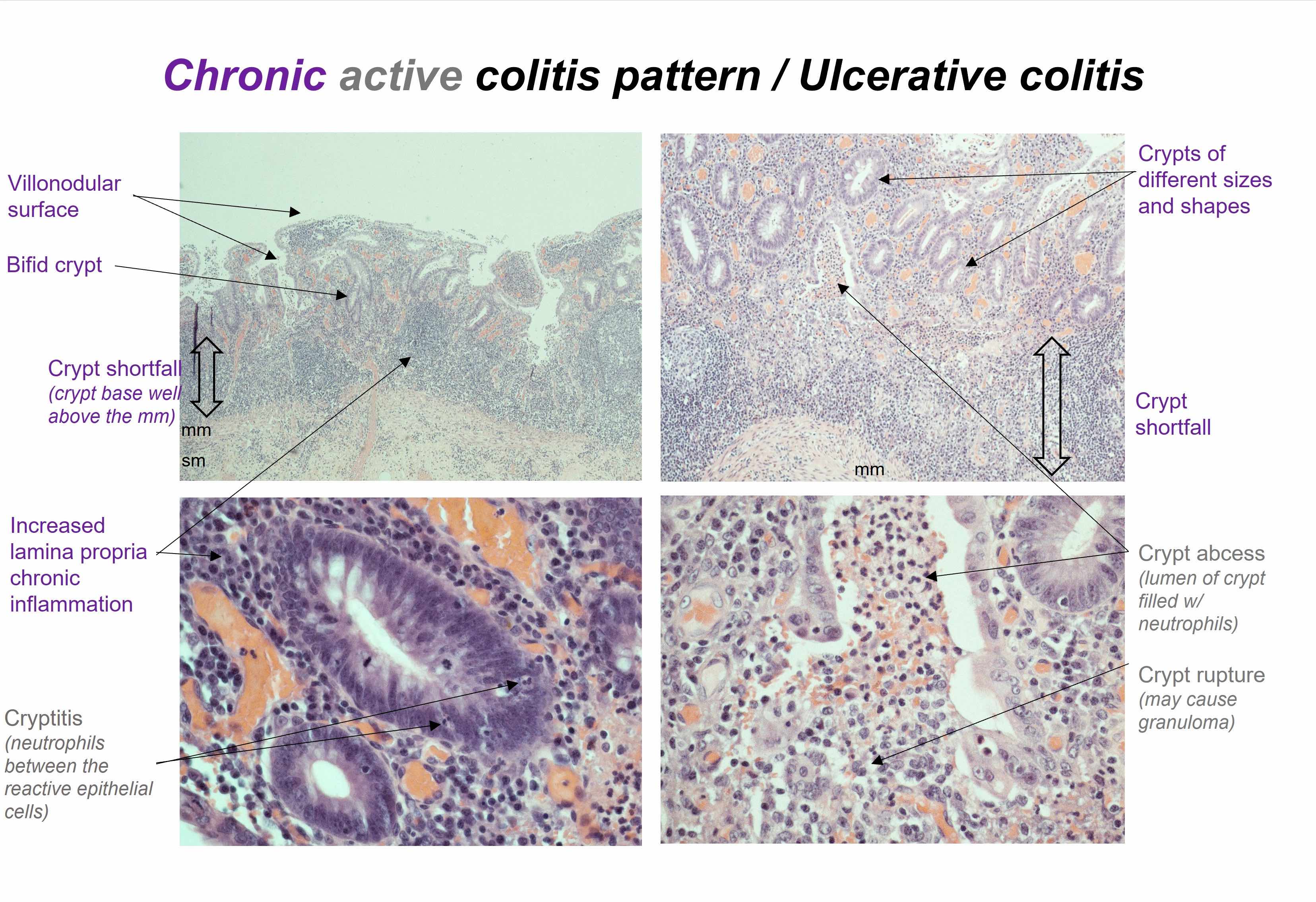 Ischemic Colitis Pathogenesis And Clinical Findings