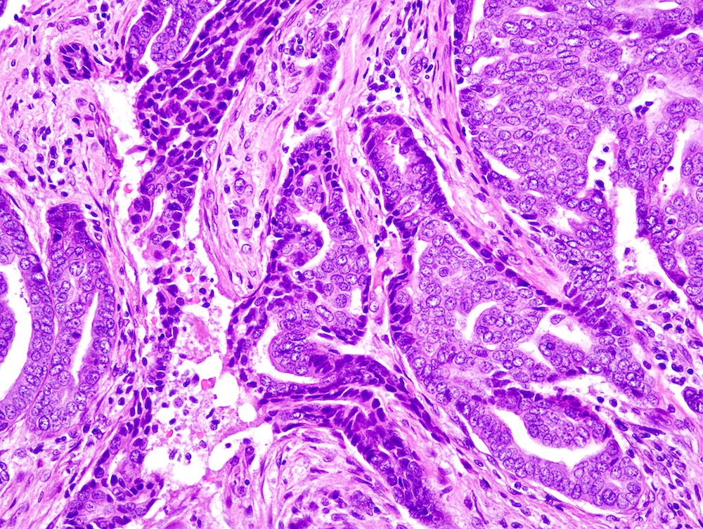 Pathology Outlines Digital papillary adenocarcinoma
