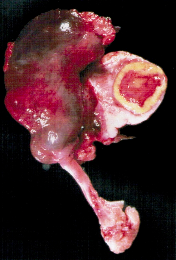 Pathology Outlines Ectopic / tubal pregnancy