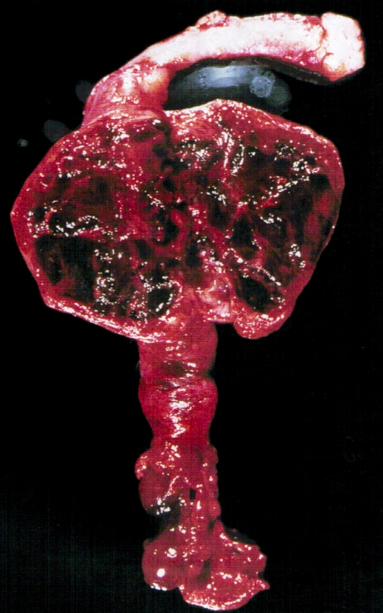 Pathology Outlines Ectopic / tubal pregnancy