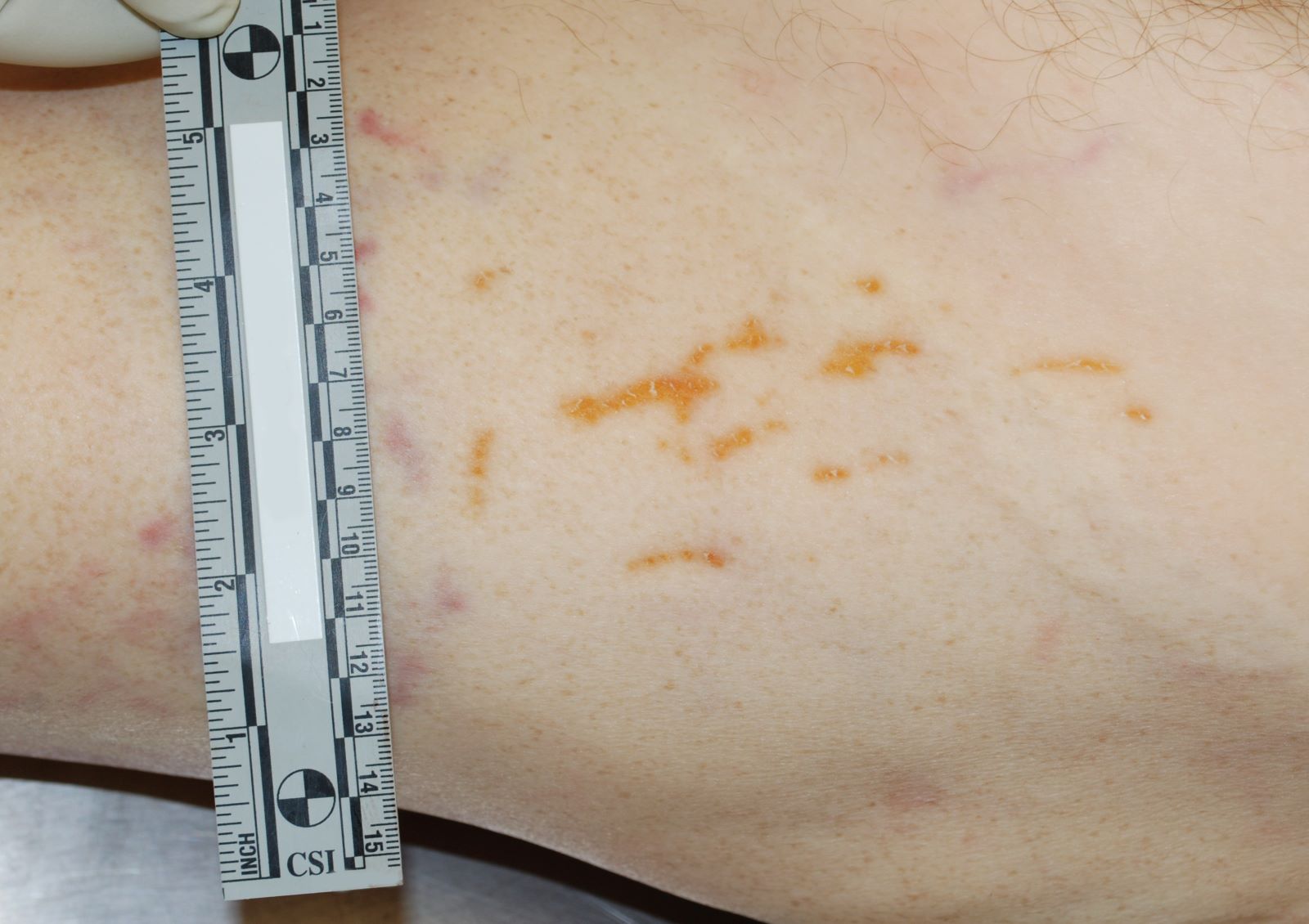 Pathology Outlines Postmortem changes