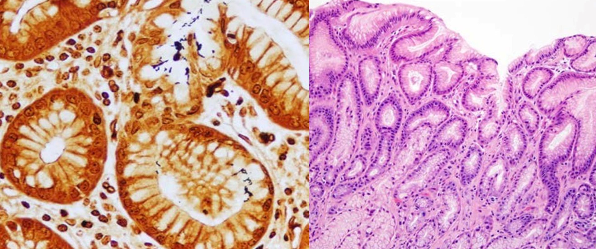 Pathology Outlines Peptic duodenitis