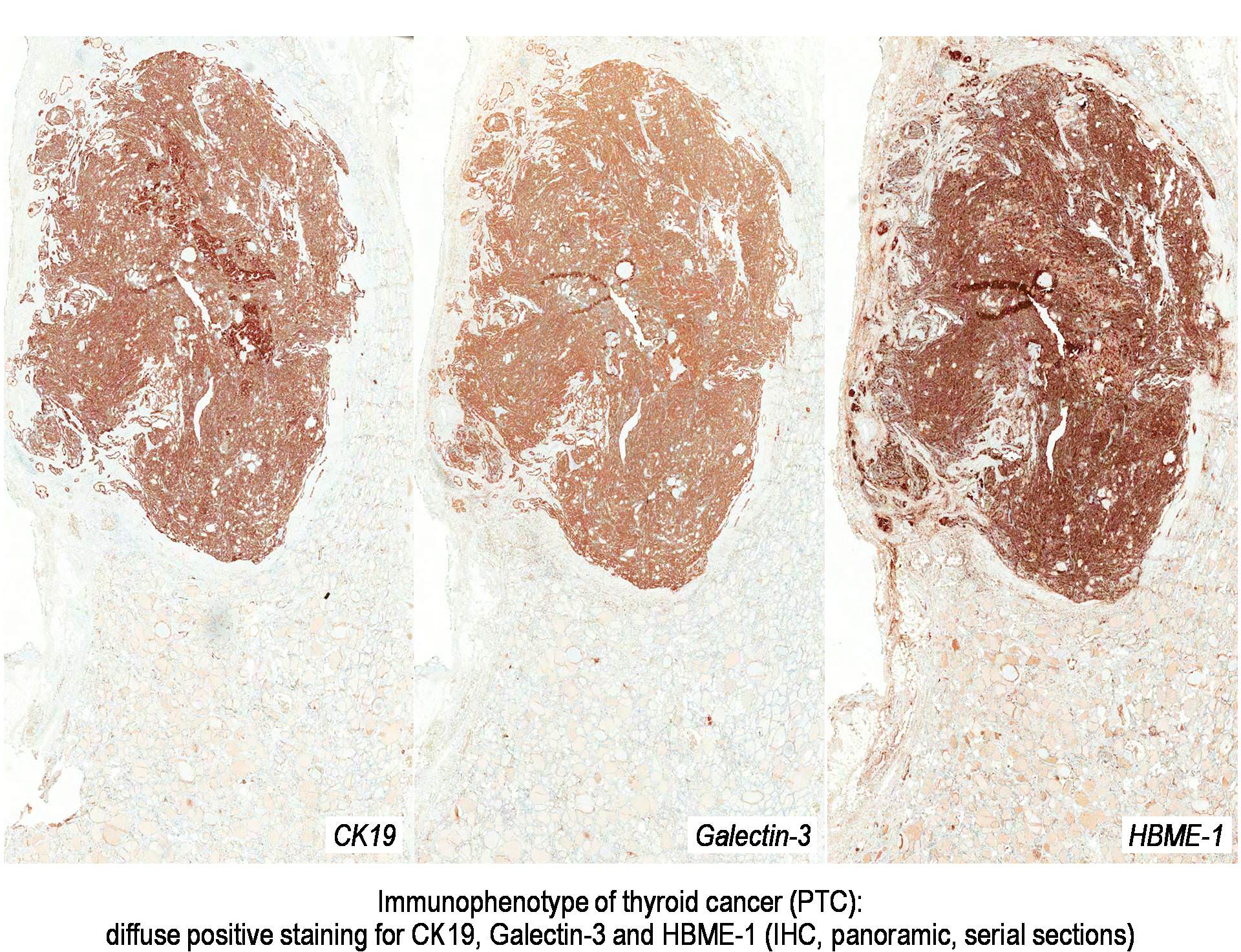 Pathology Outlines Thyroid cancer General