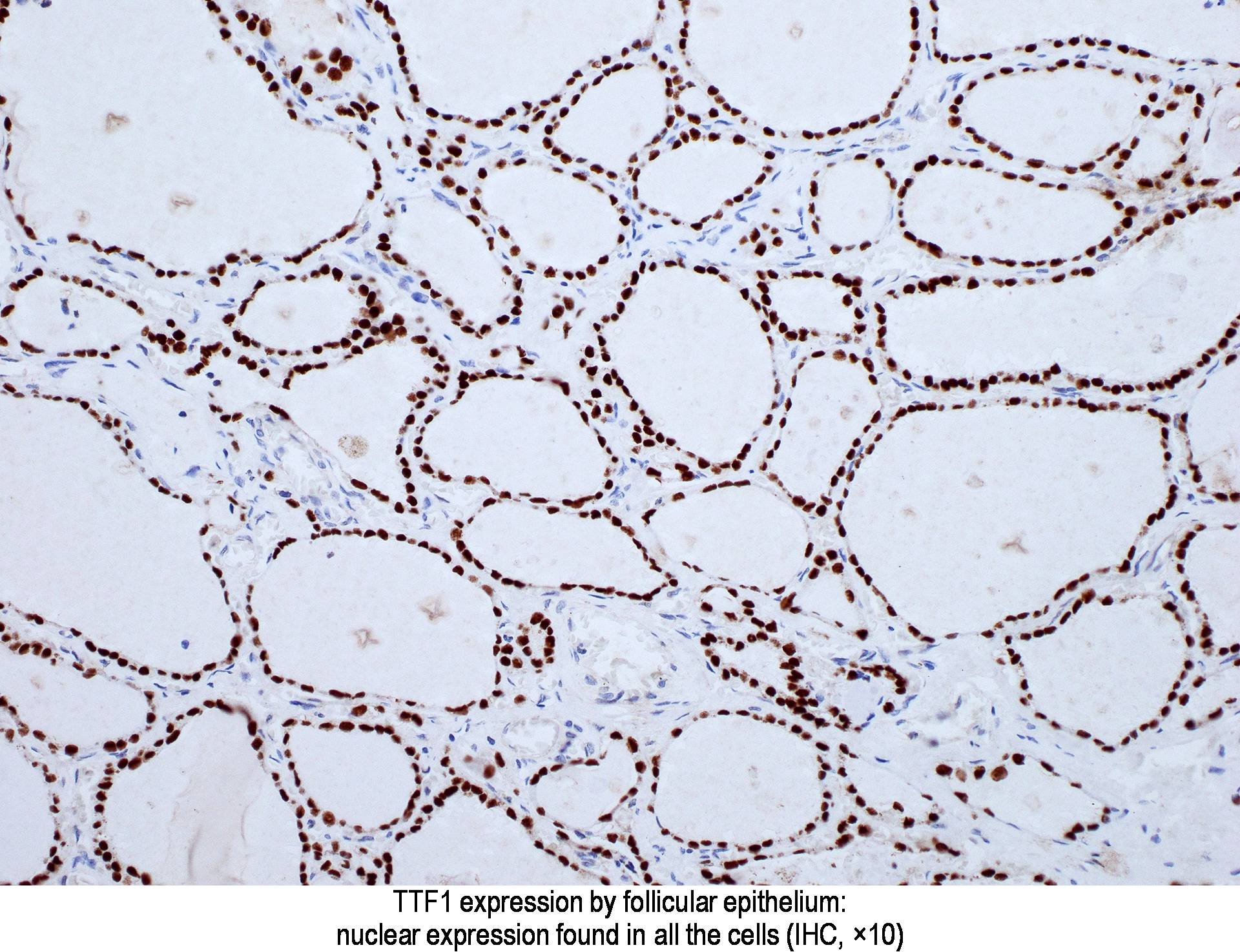 Pathology Outlines TTF1