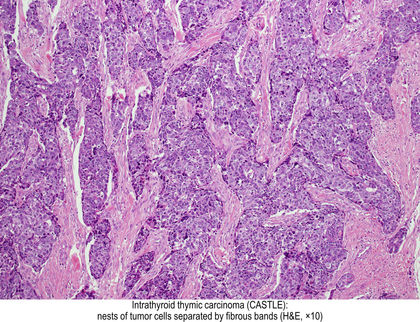 Thymic Carcinoma Rabbit at Alicia Peters blog