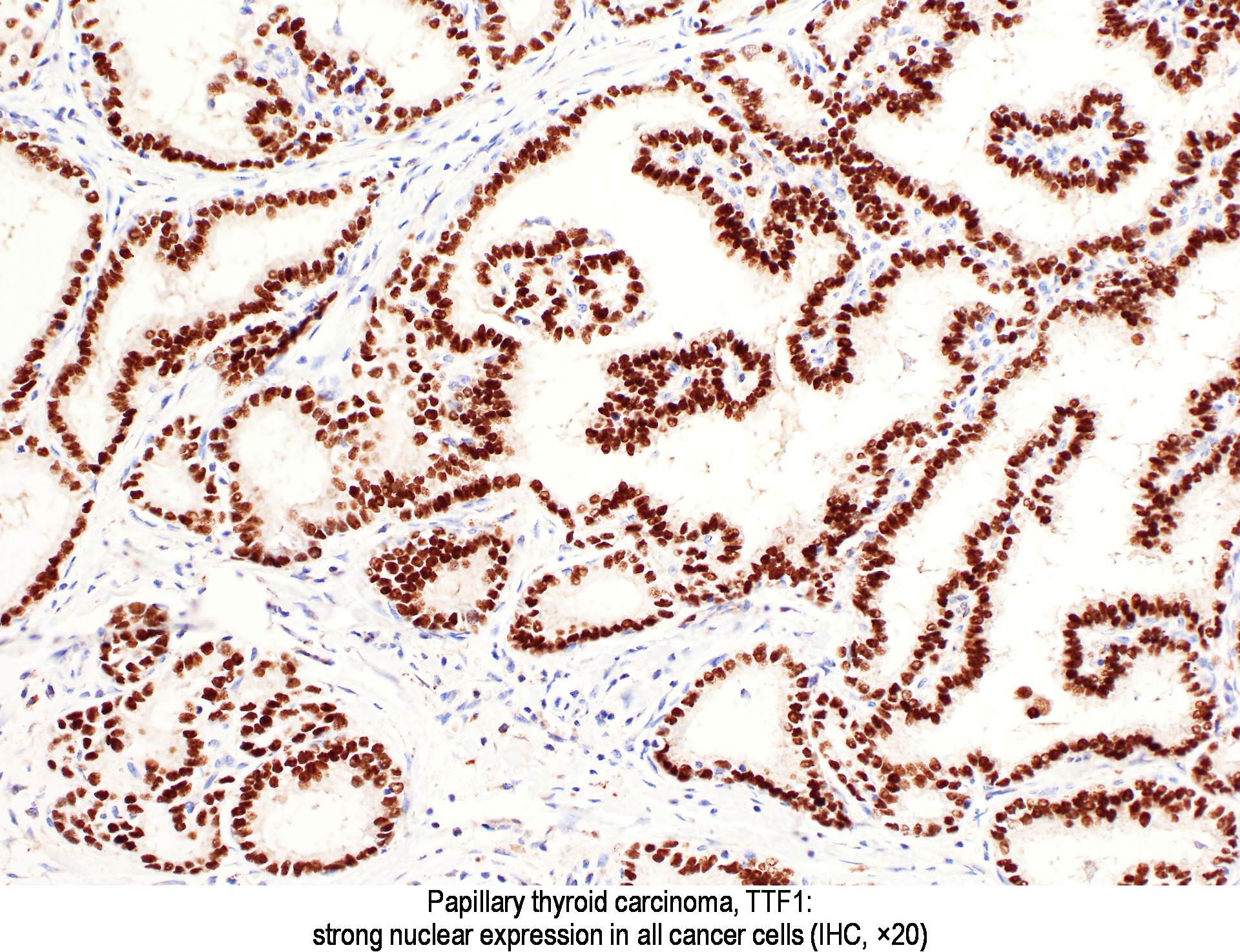 Pathology Outlines TTF1