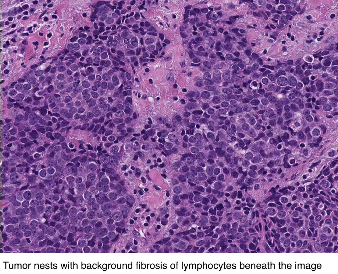 Pathology Outlines Thymoma / thymic carcinoma