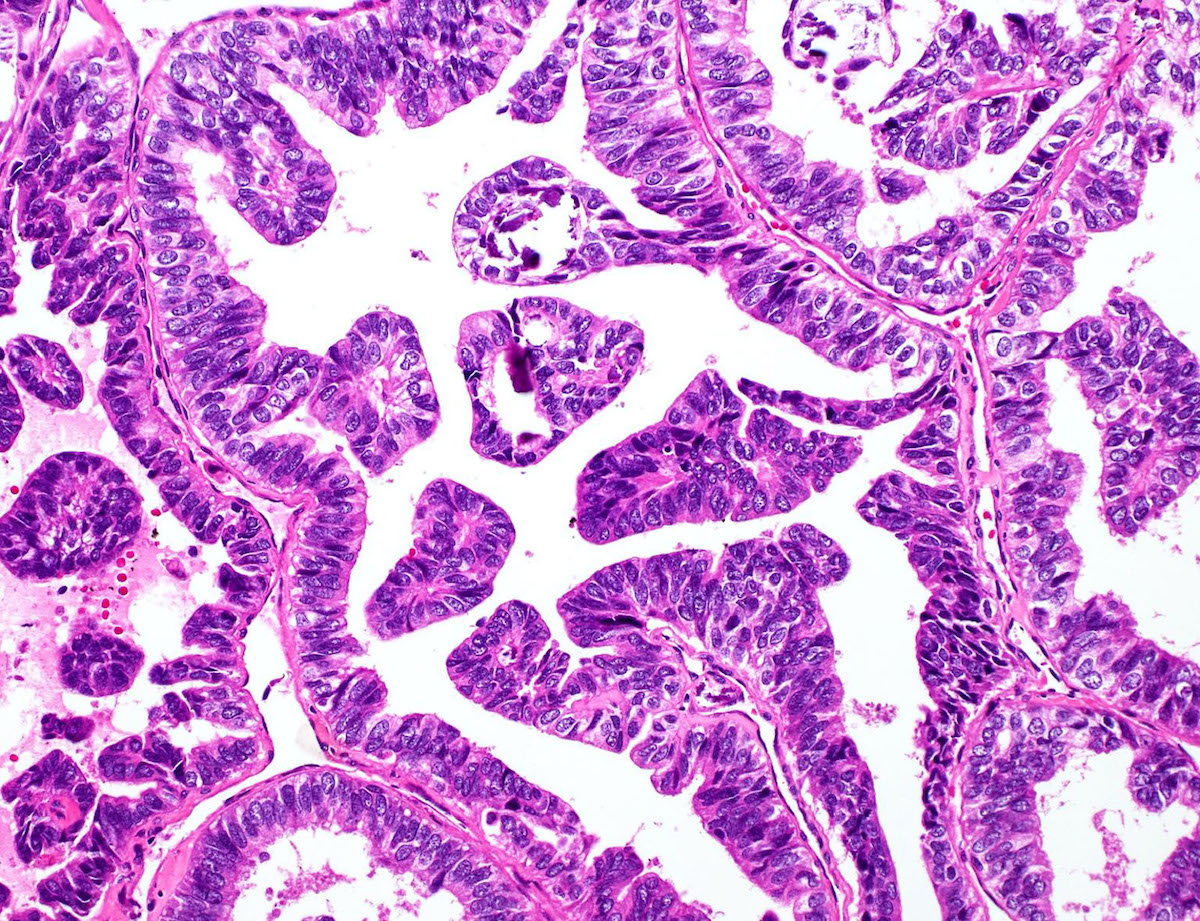 Pathology Outlines Columnar cell