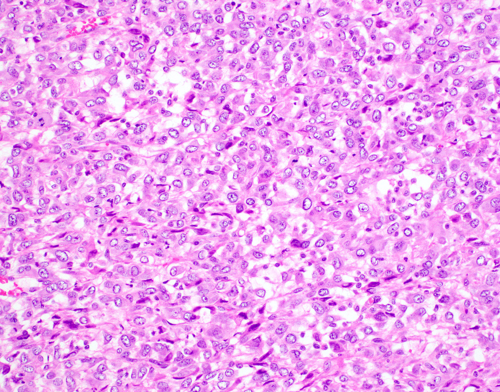 Pathology Outlines Undifferentiated uterine