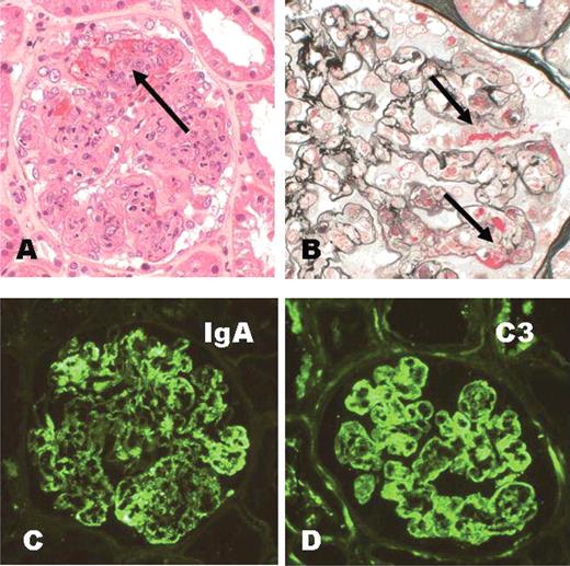 Pathology Outlines HenochSchonlein purpura (HSP)