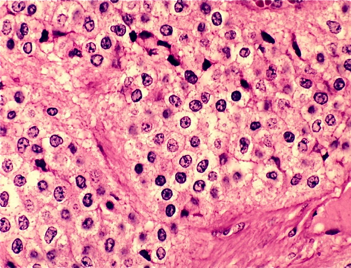 Oligodendroglioma; Oligodendroblastoma