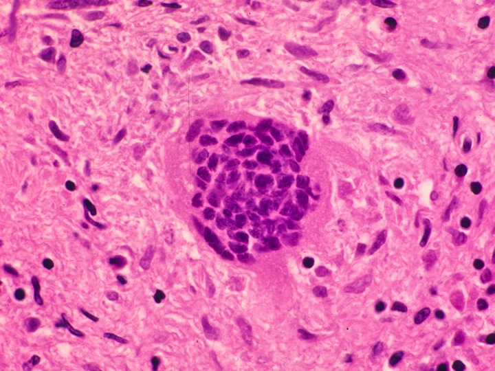 Giant cells; Giant Cells, Multinucleated; Multinucleated Giant Cells