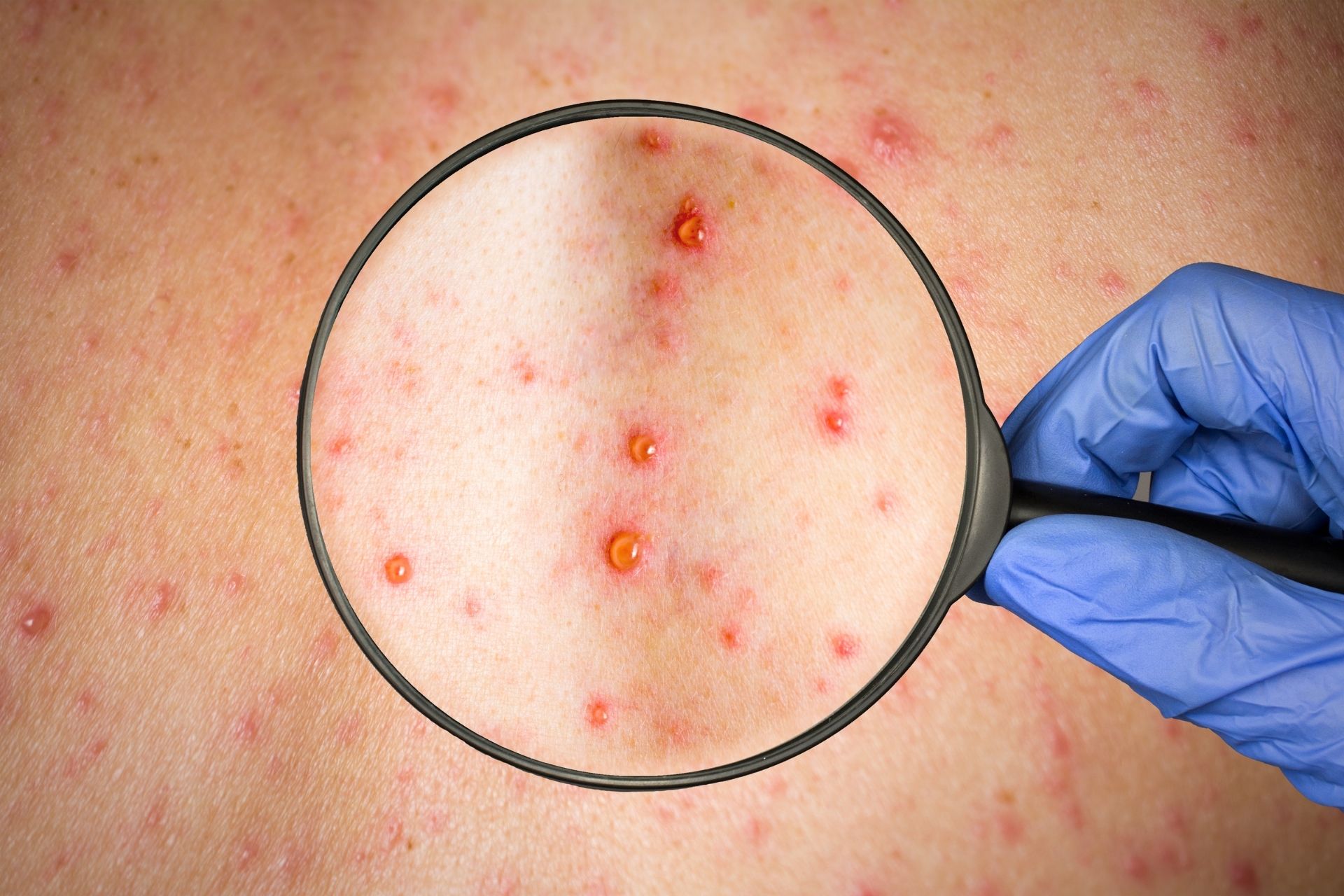 Shingles Causes and Treatments Patrick Holford