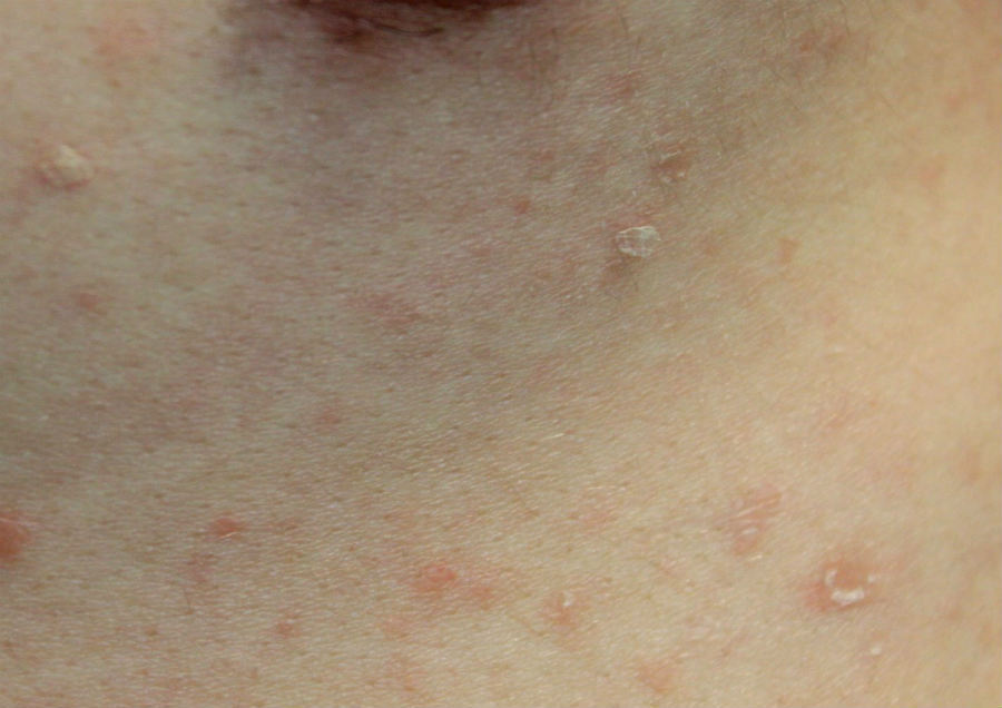 Pityriasis lichenoides