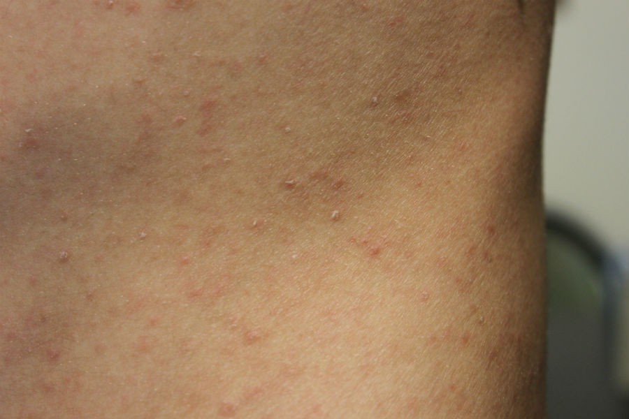 Pityriasis lichenoides