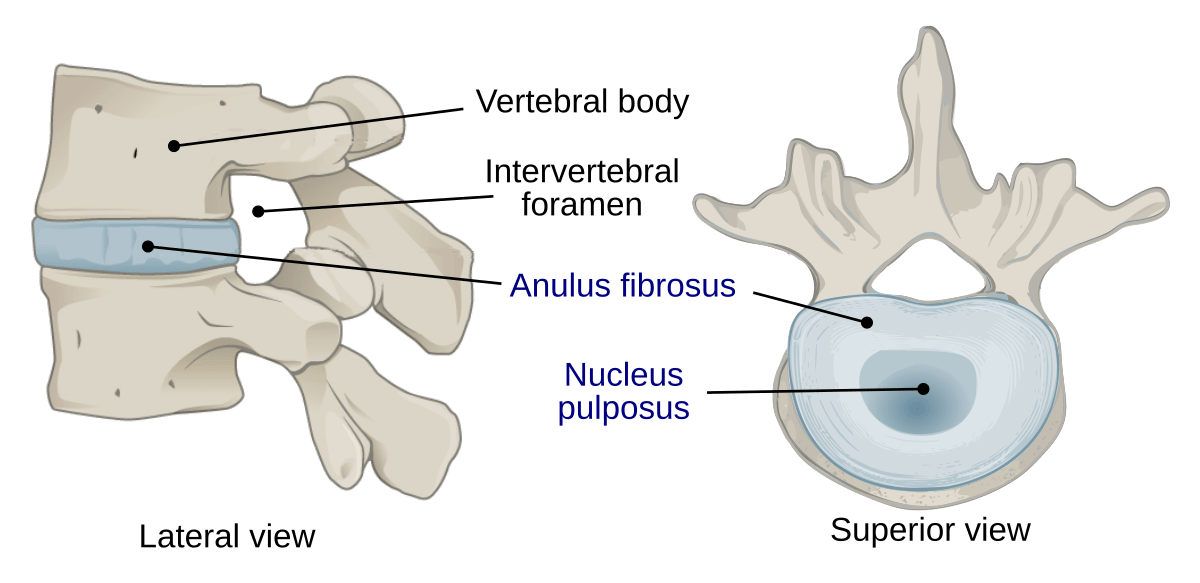 Discogenic Low Back Pain • Peak Physio