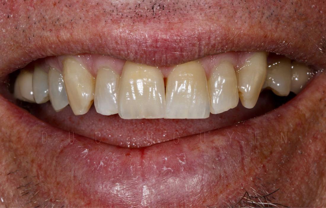 Peak Dental's Smile Gallery Crown Replacement