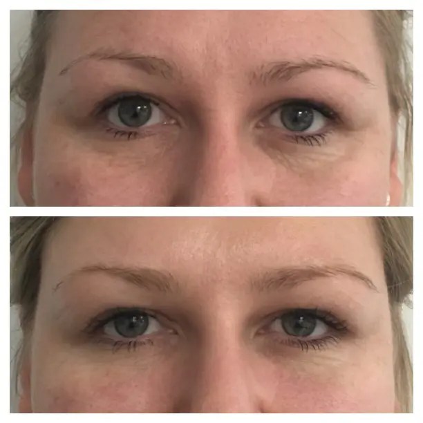 Laser for Eye Wrinkles CO2, Pico and Tixel Laser for UnderEye Wrinkles