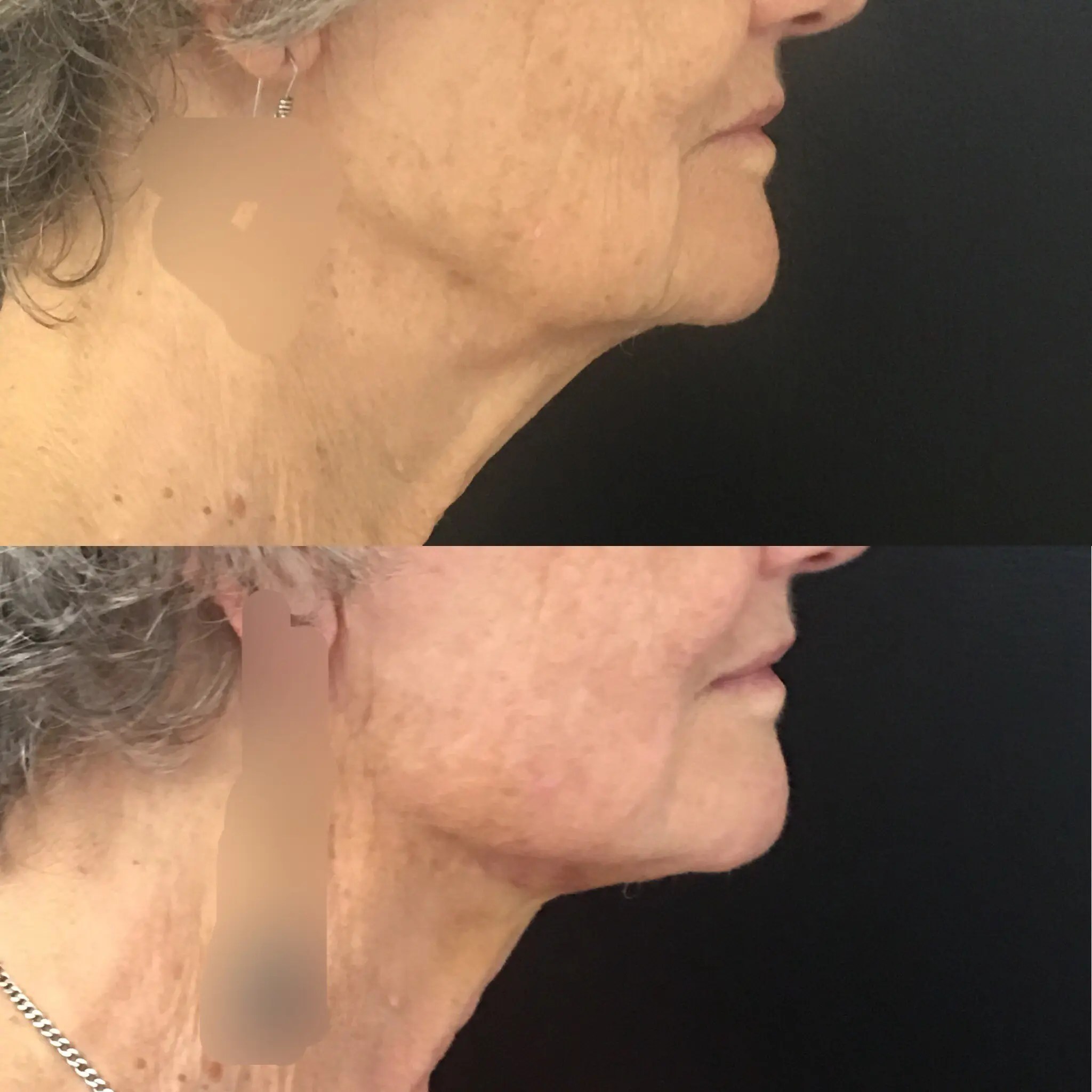 Thread Lift Brisbane Aptos, PDO & MINT Thread Facelift and Neck Lift