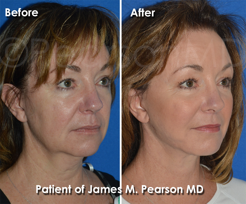 Facelift Photos Before & After Dr. James Pearson Facial Plastic Surgery