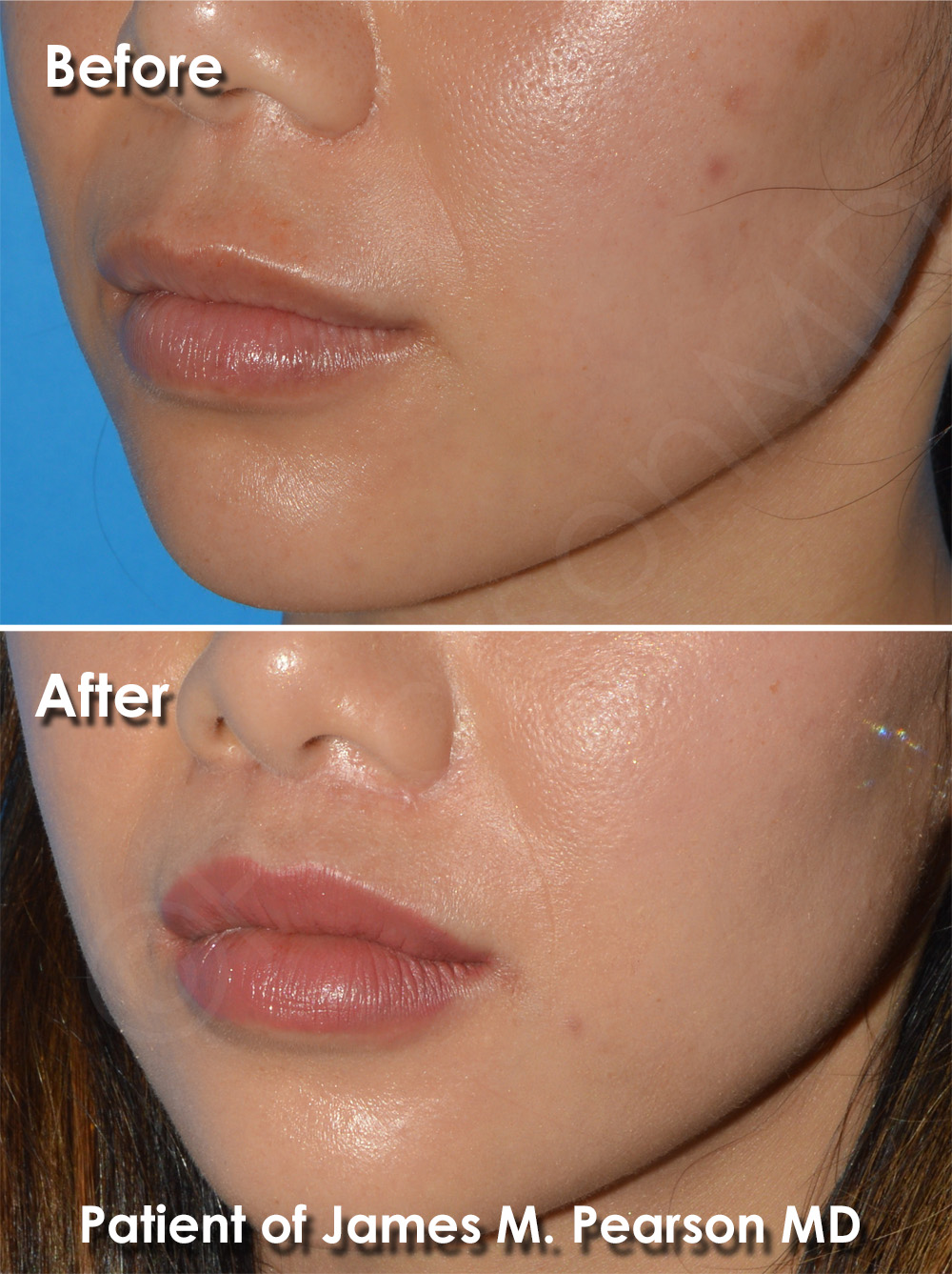 Lip Lift Photos Before & After Dr. James Pearson Facial Plastic Surgery