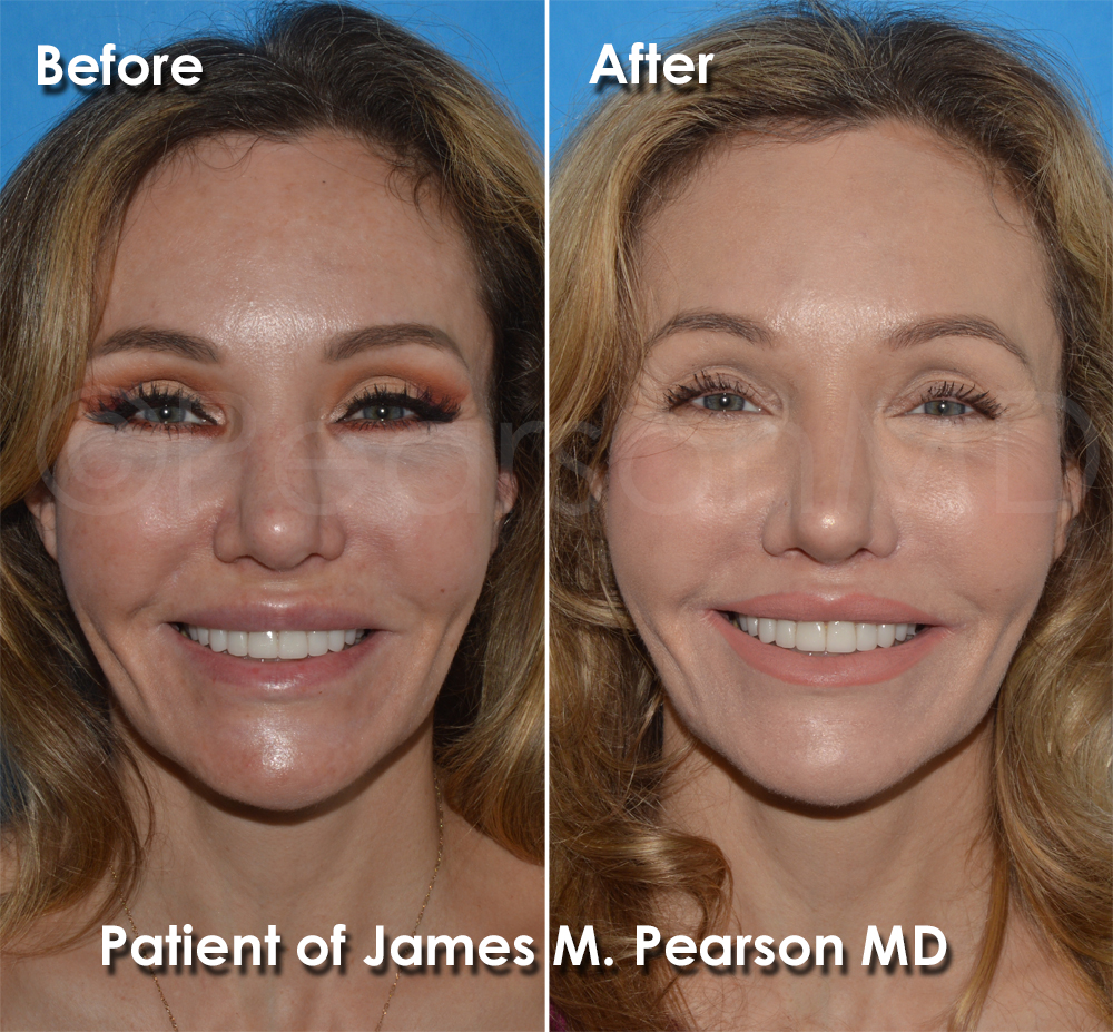 Lip Lift Photos Before & After Dr. James Pearson Facial Plastic Surgery