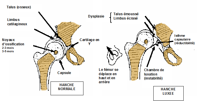 Pediaos.fr L'orthopédie pédiatrique expliquée aux parents