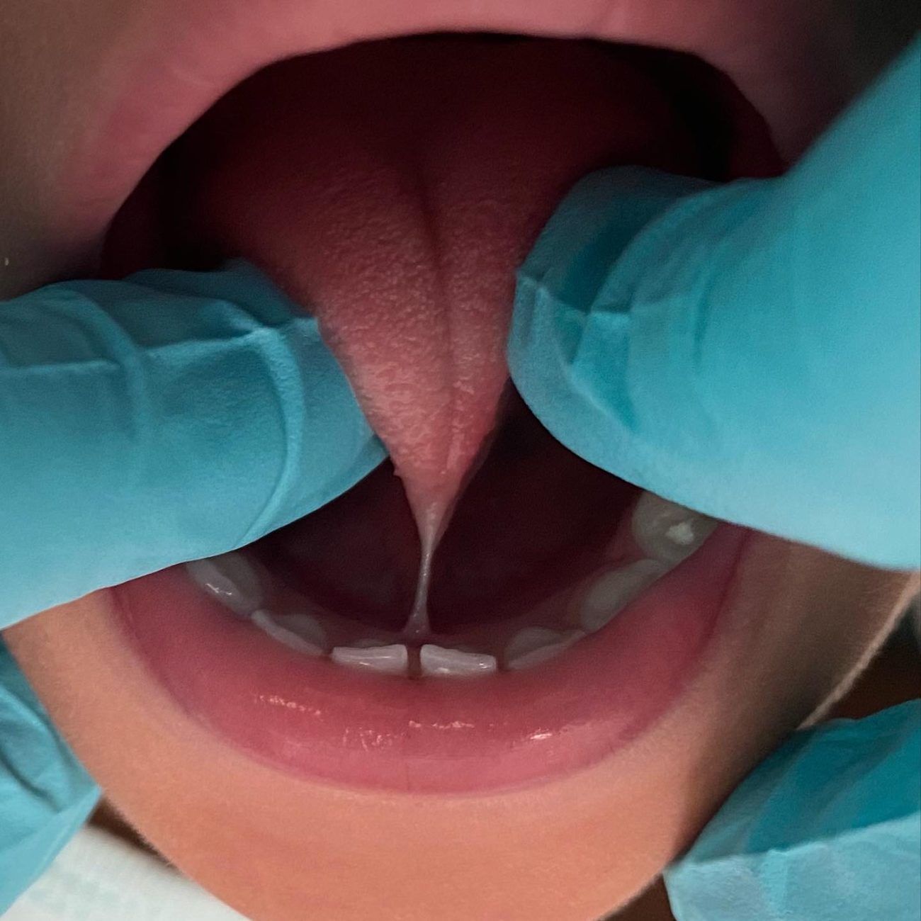 Laser Frenectomy Winter Park FL Tongue Ties Maitland