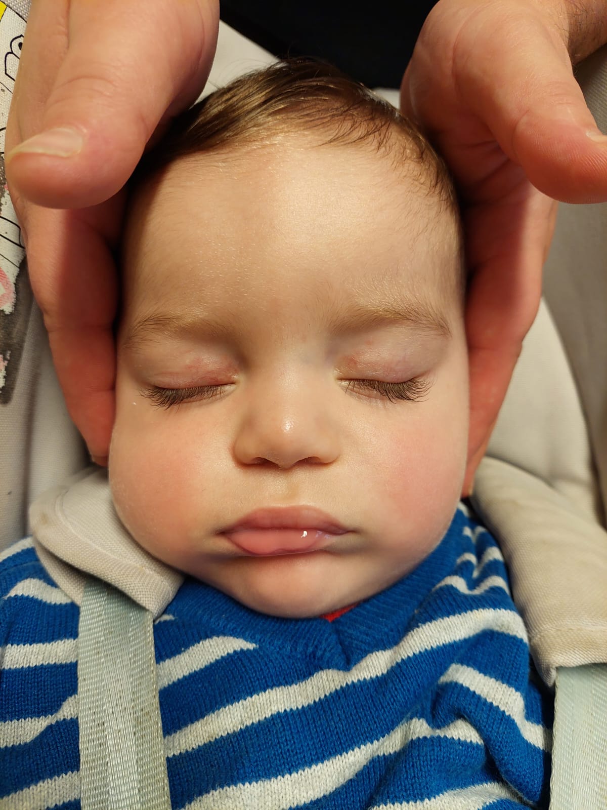 Figure 2. Symmetrical facial expression at rest with only the left