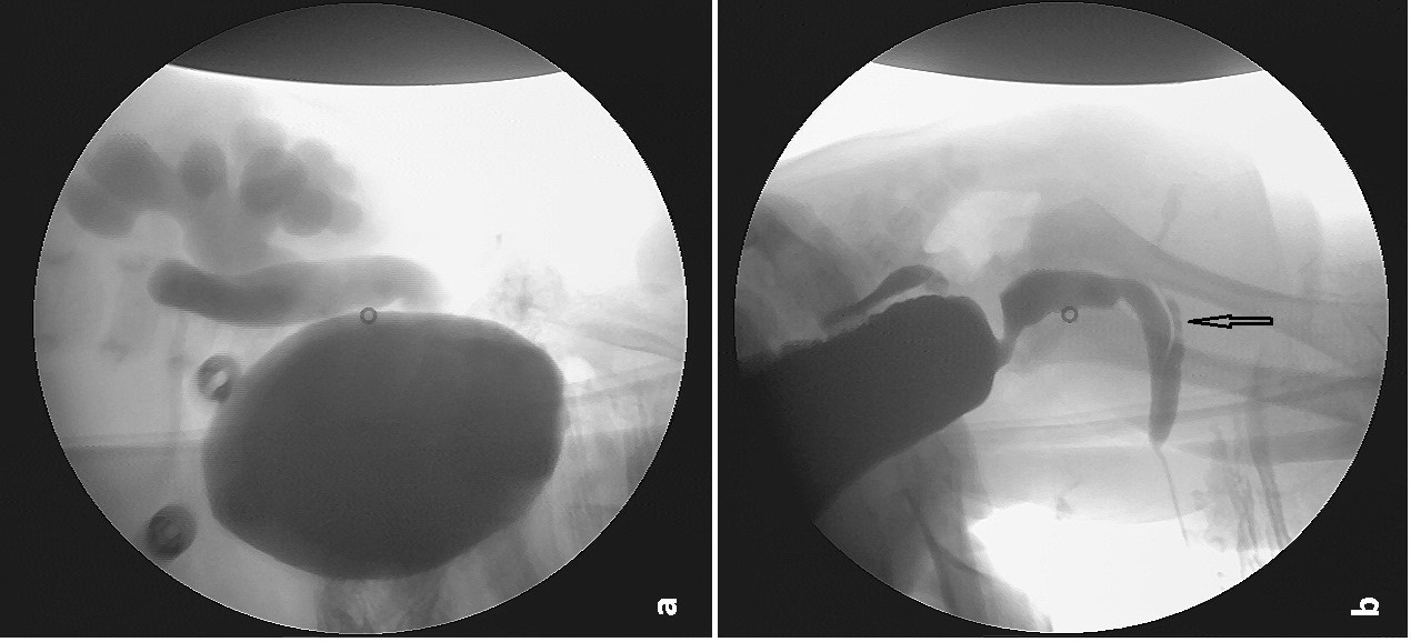 An anterior urethral valve without urethral dilatation diagnosed by