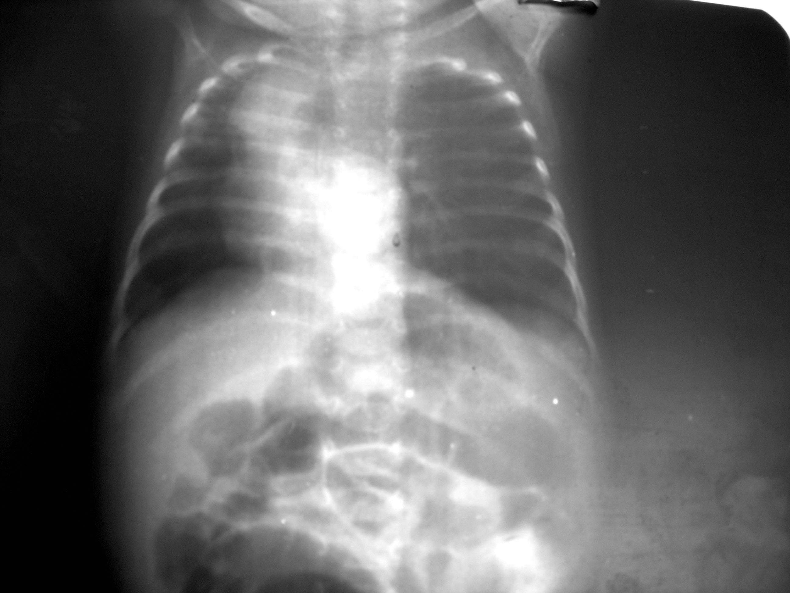 A case of unusual combination of dandy walker syndrome with congenital