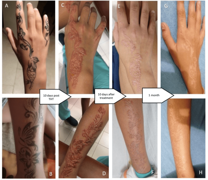 Henna temporary tattoo or permanent lesion? Pediatric Oncall Journal