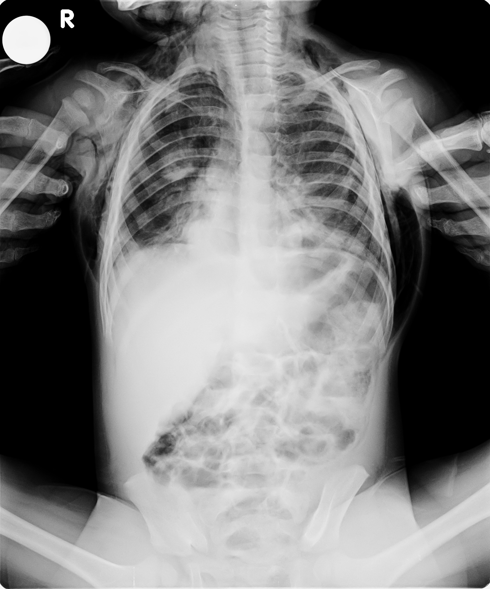 Subcutaneous Emphysema And Spontaneous Pneumomediastinum In A Toddler