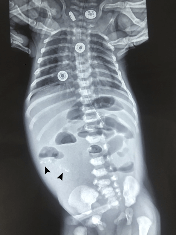 Peritoneal calcifications in a newborn Pediatric Oncall Journal