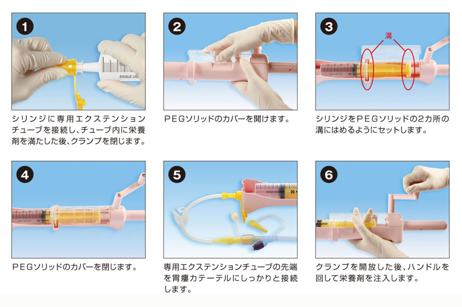胃瘻注入 手順 nacssee