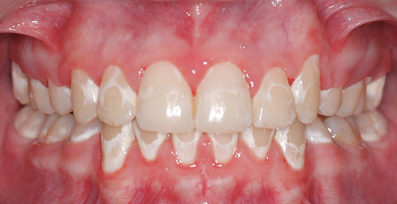 Why do I have white spots on my teeth? Peninsula