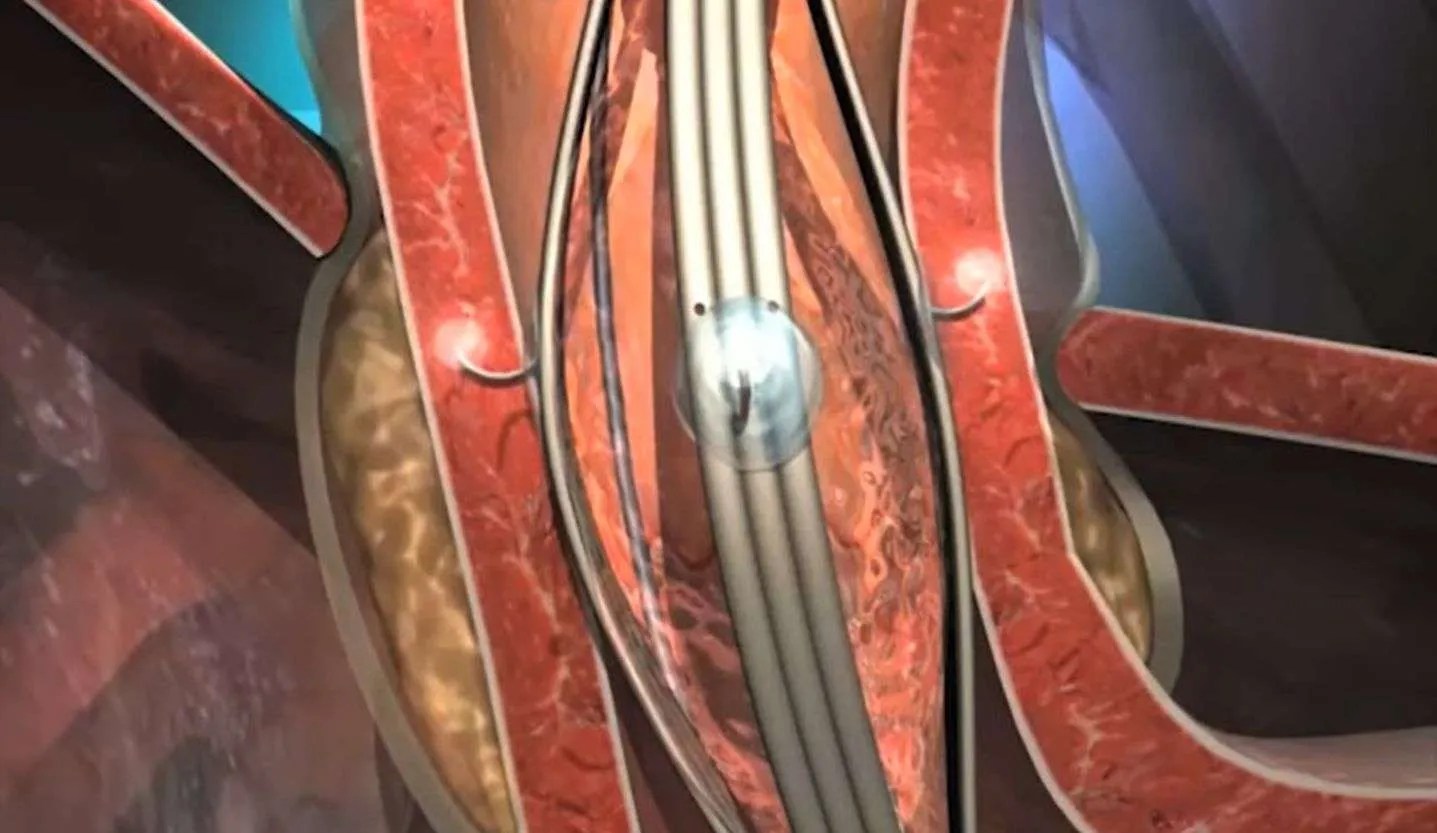 What is Stretta therapy for treating reflux? // A Peptest blog