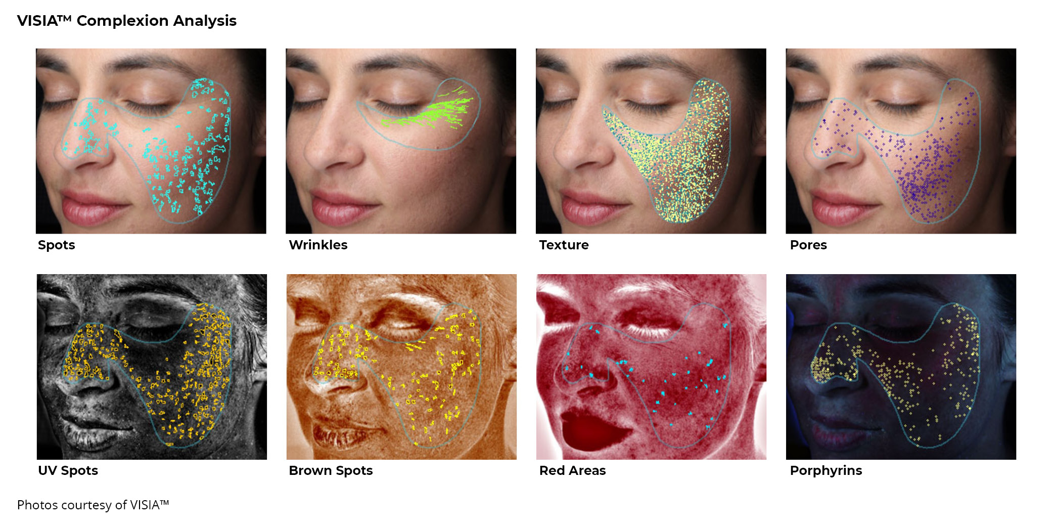 VISIA® Complexion Analysis Peraza Dermatology Group