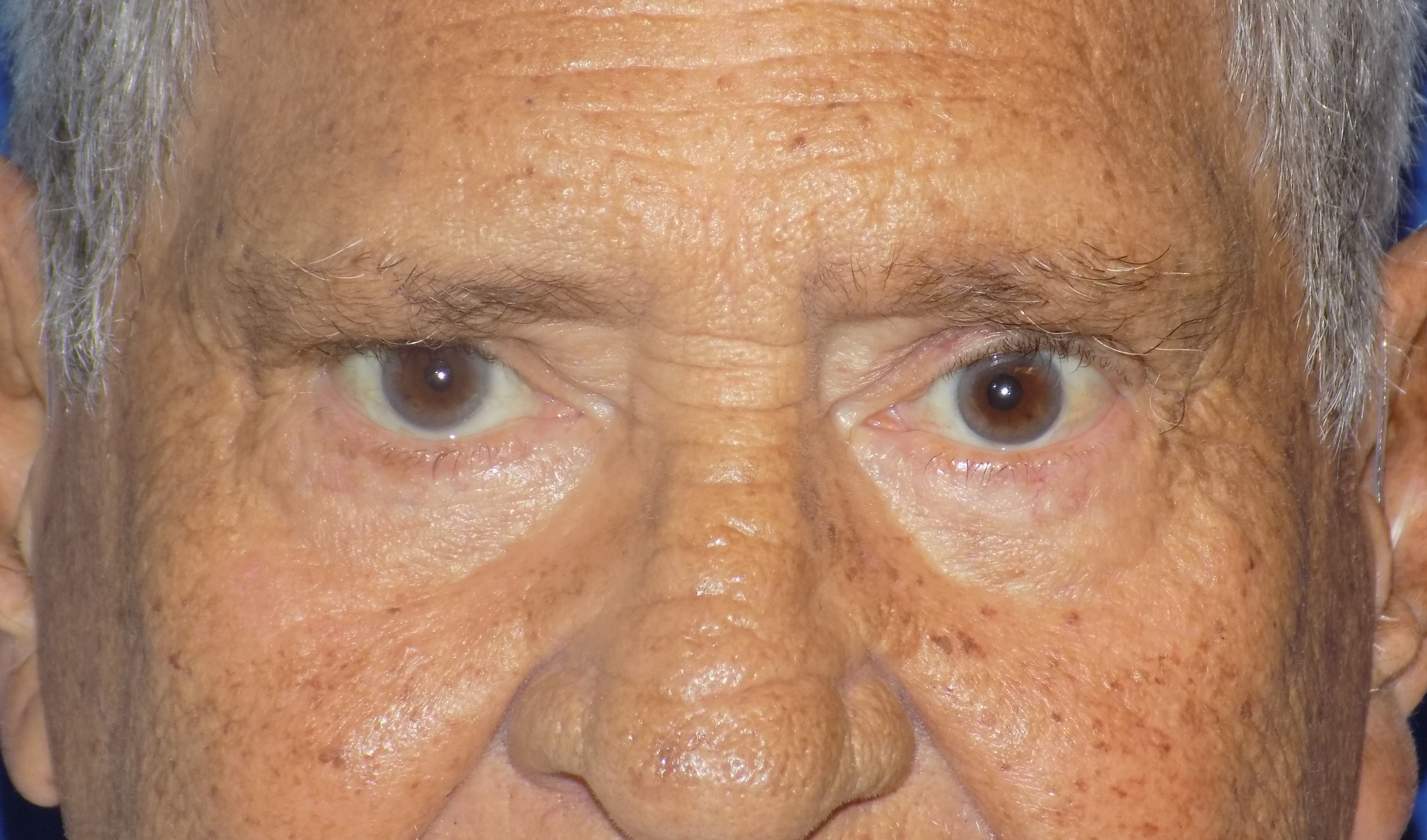 Eyelid Tuck Perez Plastic Surgery