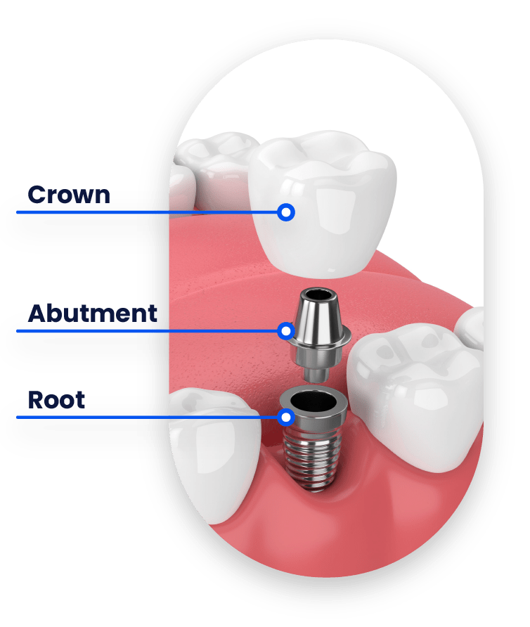 Dental Implants Memphis TN Periodontal Associates of Memphis
